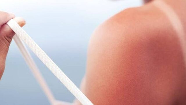 آفتاب سوختگی چیست؟ | معرفی راه های درمان و پیشگیری از آفتاب سوختگی