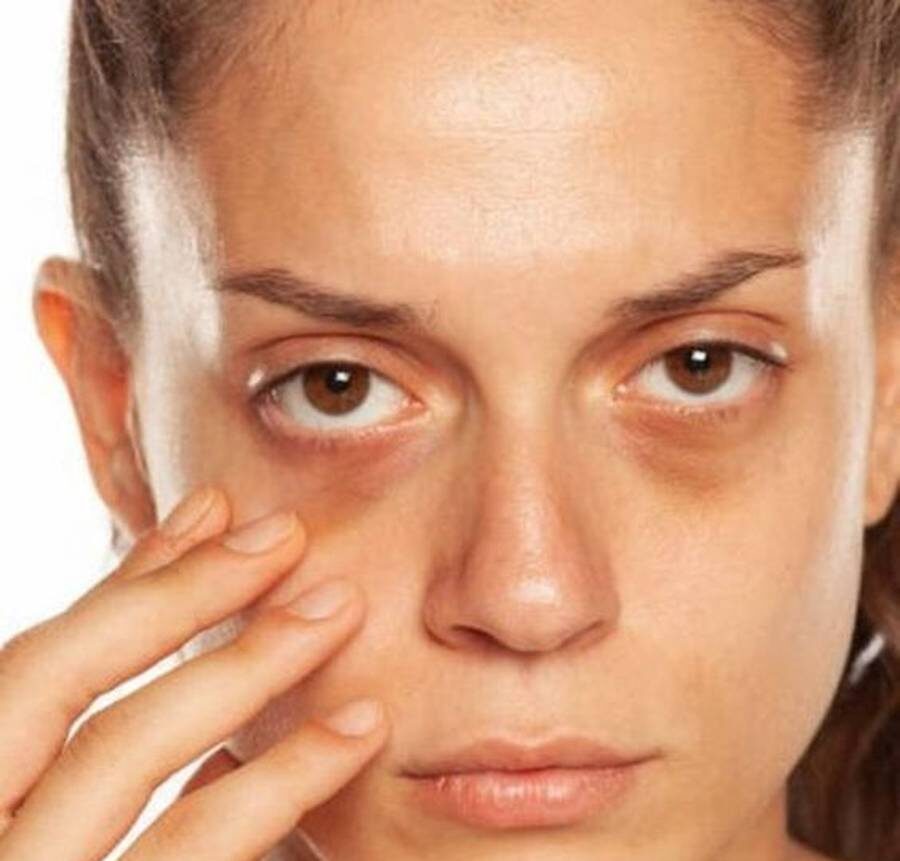 رفع گودی زیر چشم نی نی سایت