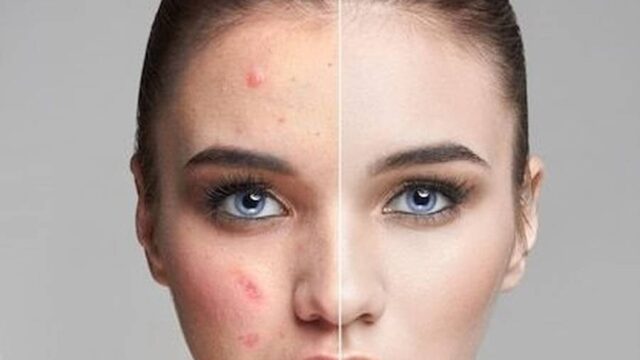 علت ایجاد جوش زیر پوستی چیست؟ | معرفی بهترین راه های درمان جوش زیر پوستی