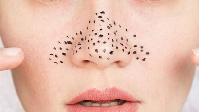 طرز تهیه ماسک های خانگی برای رفع جوش سر سیاه | معرفی راهکار های طبیعی و عملی