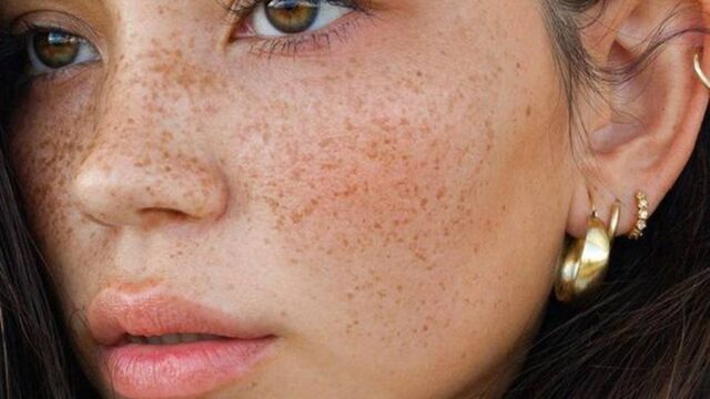 درمان کک و مک صورت با لیزر؛ مزایا و معایب این روش جدید چیست؟