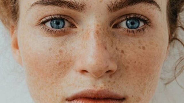 موثرترین راه های درمان کک و مک صورت با روش های طبیعی؛ ارائه نکات بسیار مهم