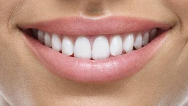 لمینت دندان چیست و چرا انجام می شود؟ + مزایا و معایب لمینت دندان