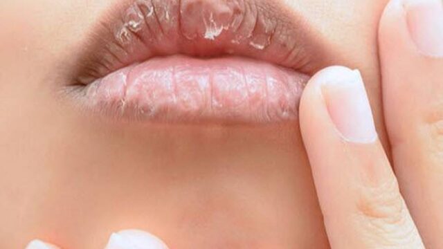 درمان سیاهی لب با روش های کاربردی؛ علت سیاه شدن لب چیست؟