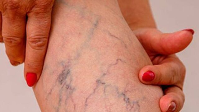 بهترین و موثرترین روش های درمان گیاهی واریس؛ با چه گیاهانی واریس درمان میشه؟