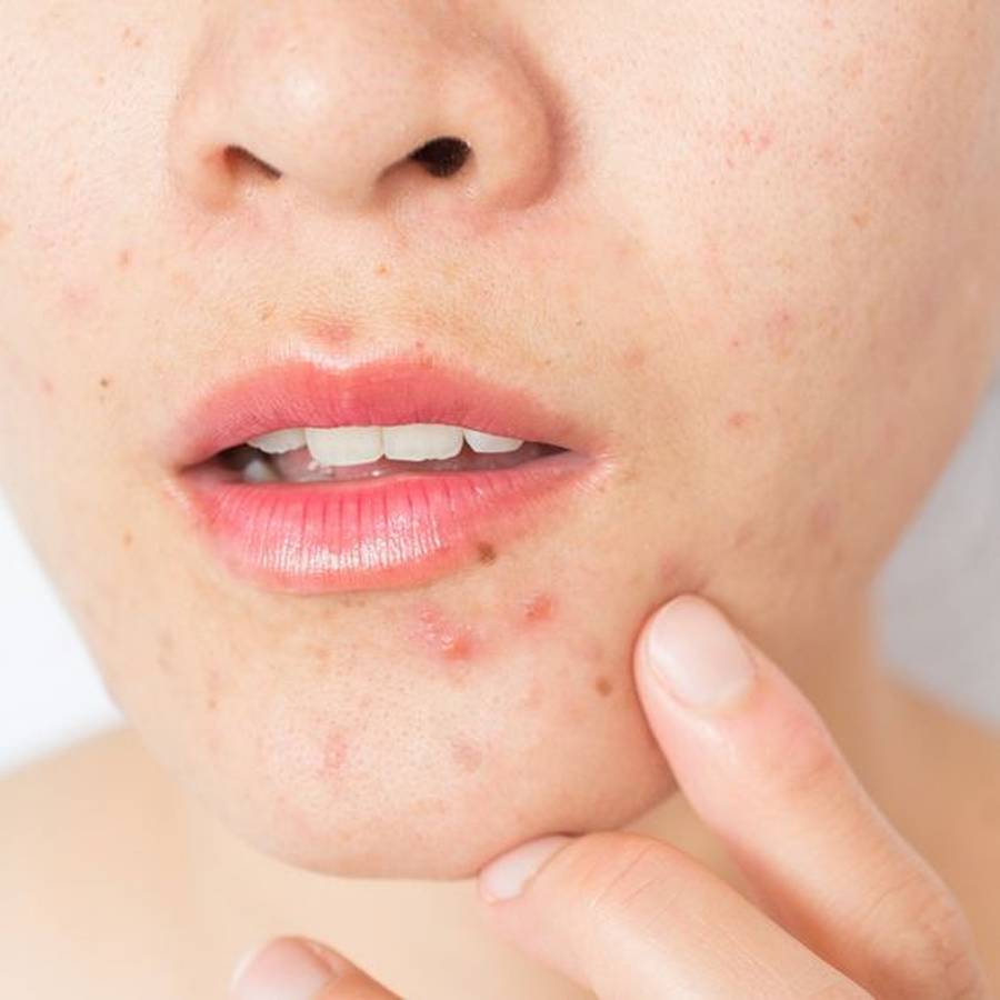 جوش گرمازدگی نی نی سایت