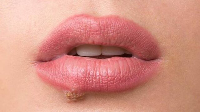 تفاوت های تبخال و جوش | چطور هرکدام را به سرعت درمان کنیم؟