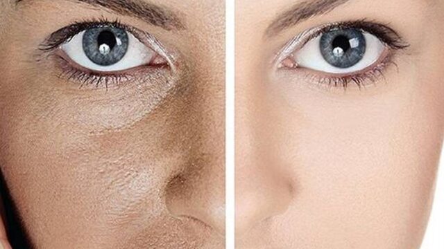 موثرترین و بهترین روش های از بین بردن تیرگی پوست؛ حتما این مطلبو بخون