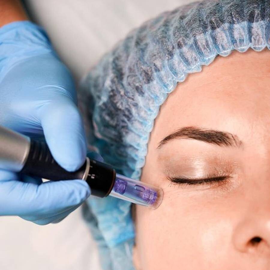 مزوتراپی پوست صورت