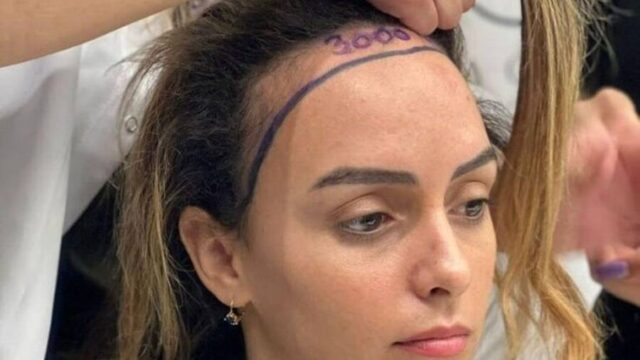 اقدامات مهم بعد از کاشت مو؛ این نکات مهم و کاربردی رو از دست نده