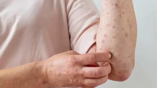 برای خارش ابله مرغون چی خوبه؟ + بهترین و شگفت انگیزترین راه